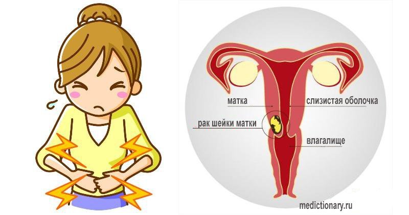 Рак шейки матки инфографика