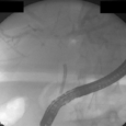 Рентгеновское изображение холангиоскопии в желчной обструкции