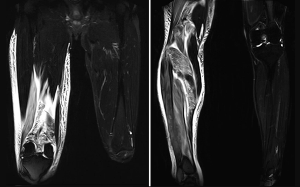 изображения МРТ показывают разбухшую ткань в ноге пациента