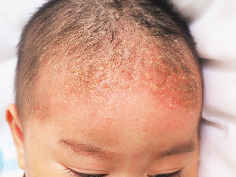 себорейный дерматит на волосистой части головы ребенка