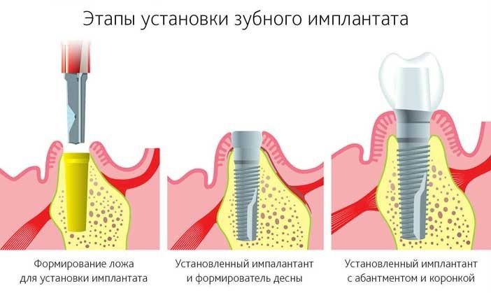 этапы установки зубного имплантата