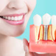 Особенности и положительные критерии имплантации зубов