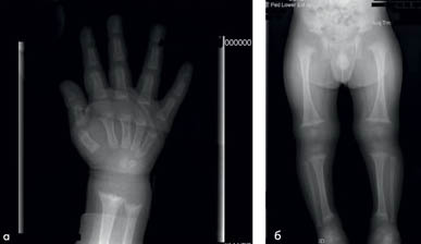 рентгеноснимок пациента с рахитом