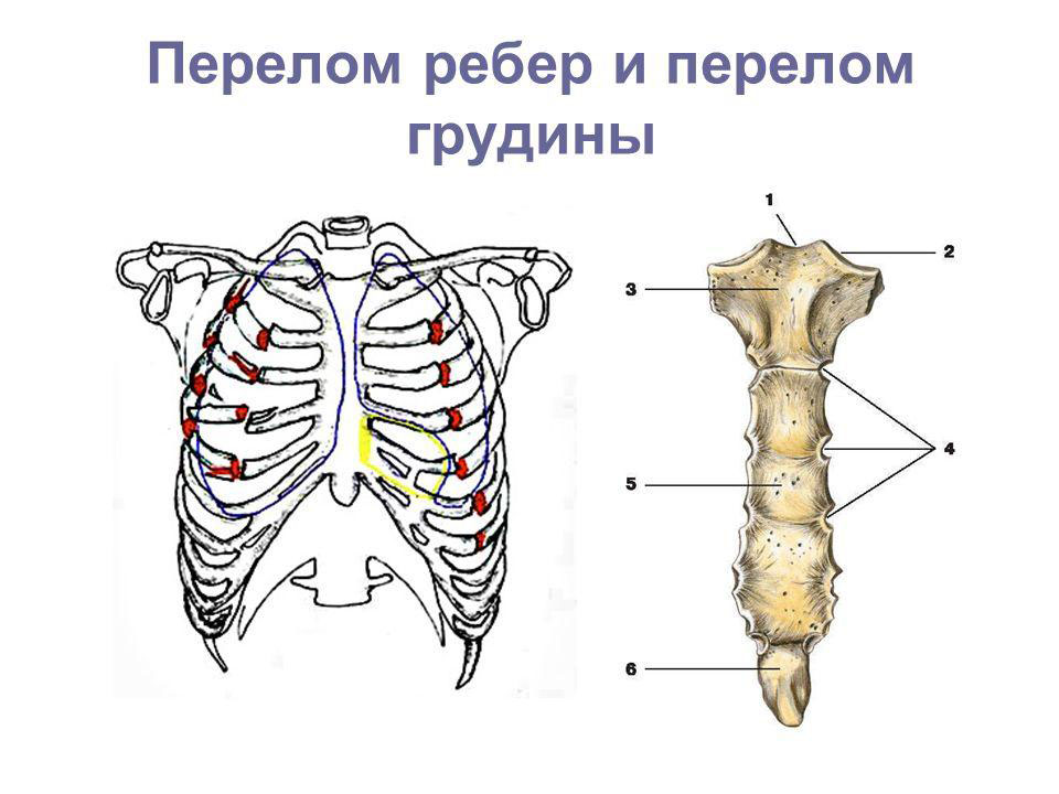 Схематичное изображение перелома ребер и грудины