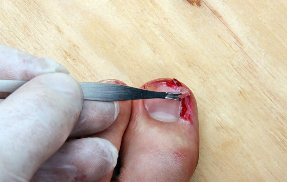 Удаление вросшего ногтя на большом пальце левой ноги