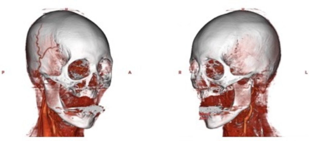Компьютерная томография головы