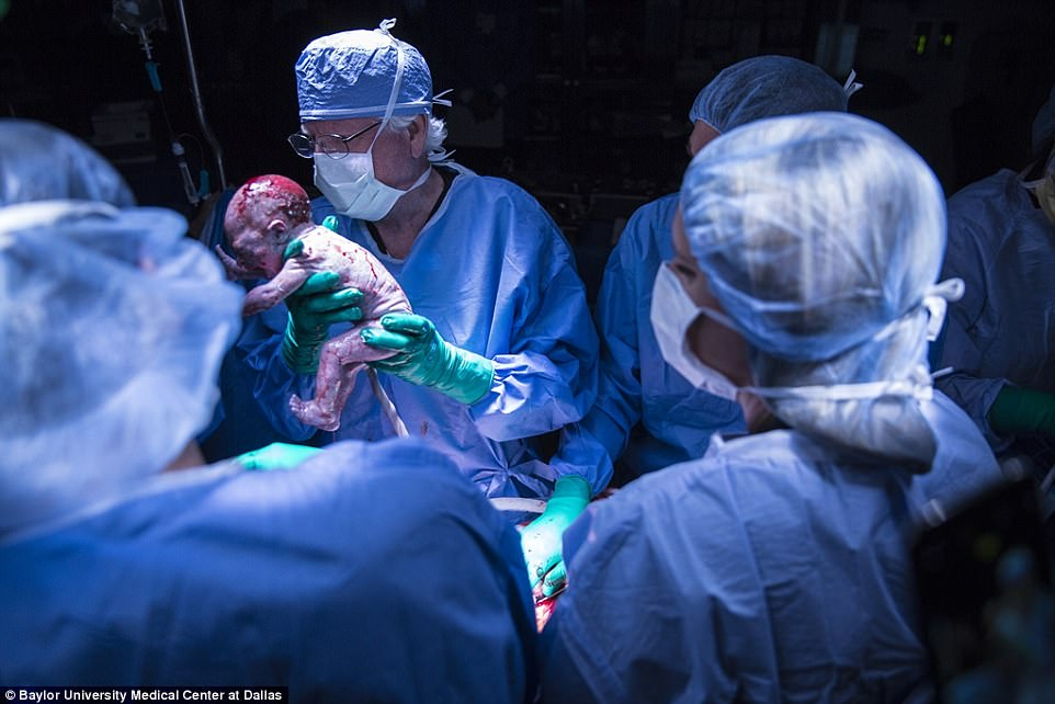 Первый американский ребенок после трансплантации матки родился в Далласе.