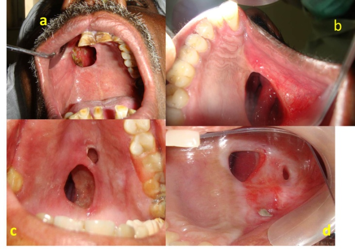 Рак полости рта