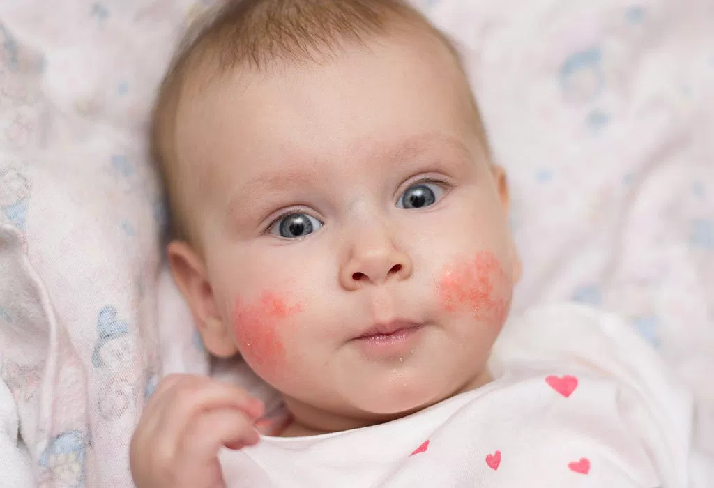 красные щеки при парвовирусной инфекции у детей