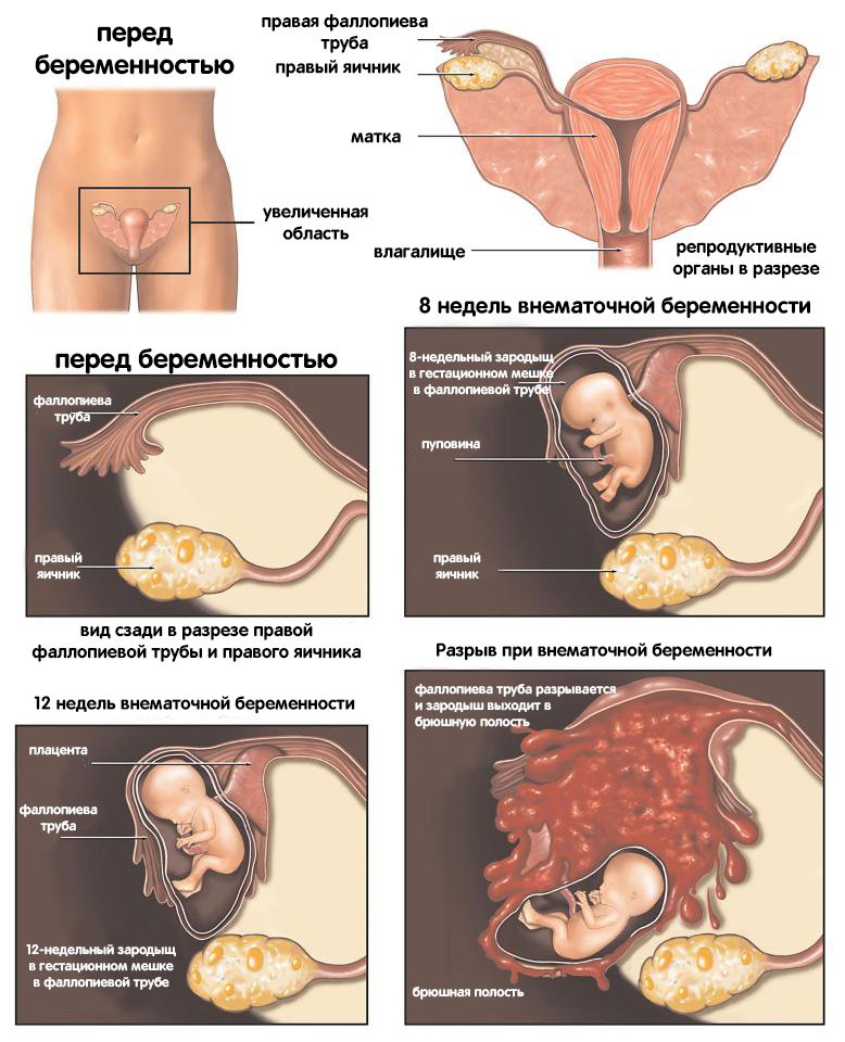 инфографика внематочной беременности