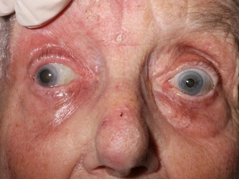 как герпес влияет на глаза у пожилых