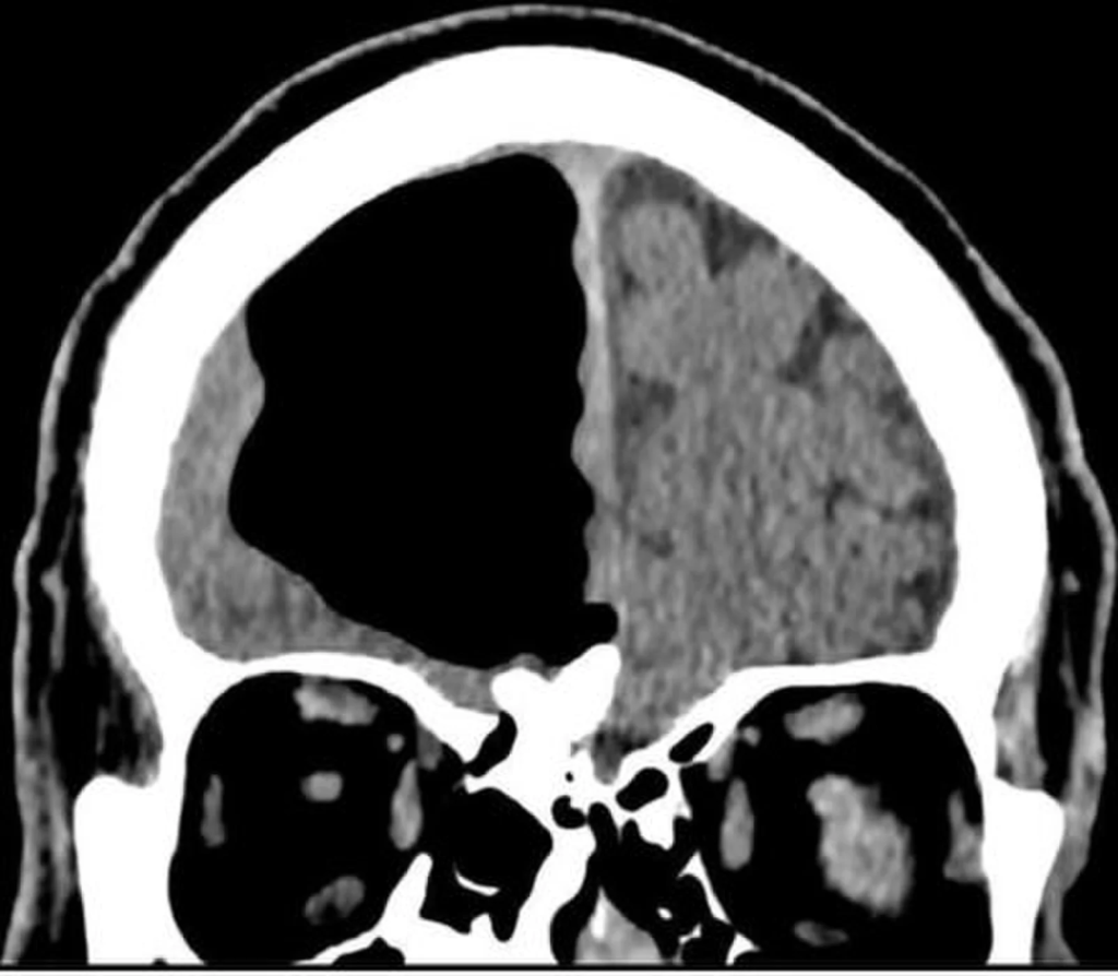 КТ-сканирование мозга