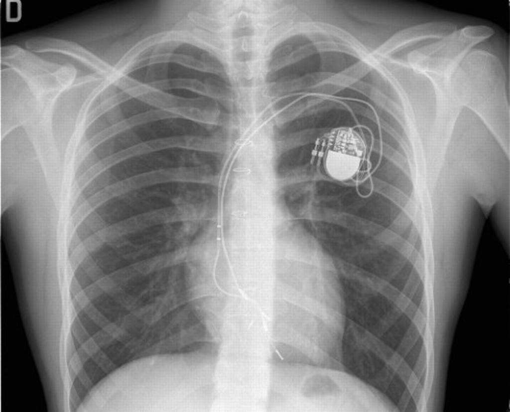 Кардиостимулятор на рентгене