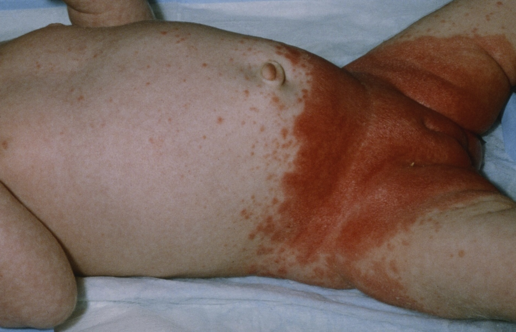 инфантильный себорейный дерматит в зоне подгузника