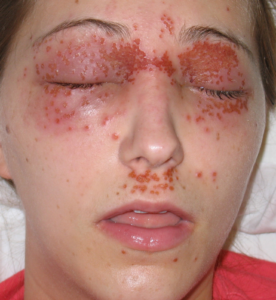 Вирусное заболевание кожи лица