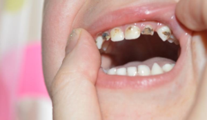 Молочные зубы тоже нужно лечить от кариеса