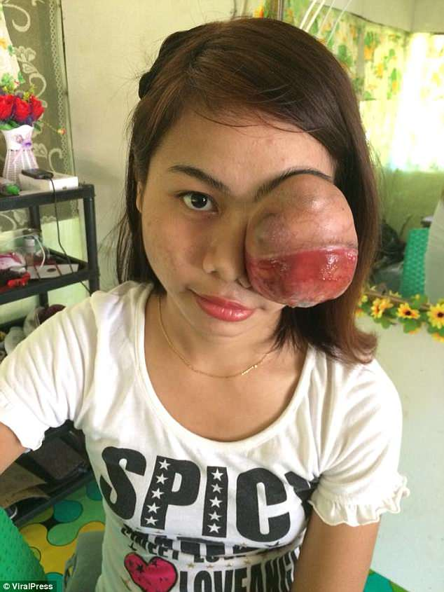 Софья Савиллага имеет опухоль размером с теннисный мяч, растущую из ее левого глаза