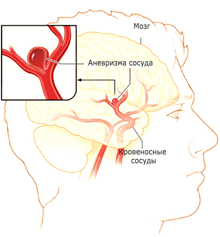 аневризмы головного мозга