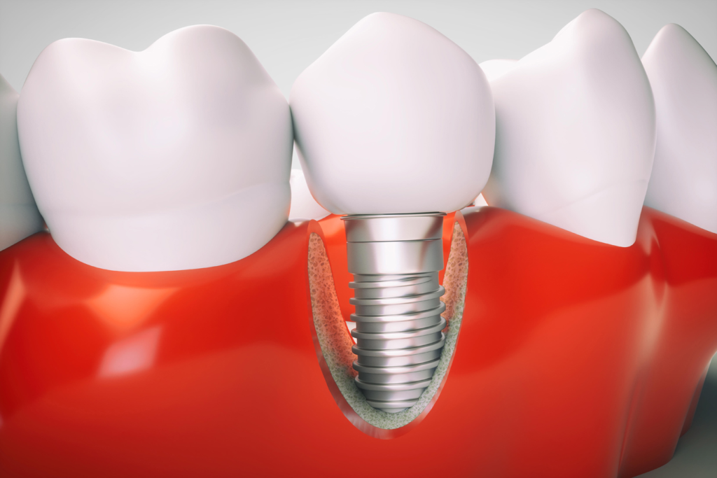Что такое зубной имплантат