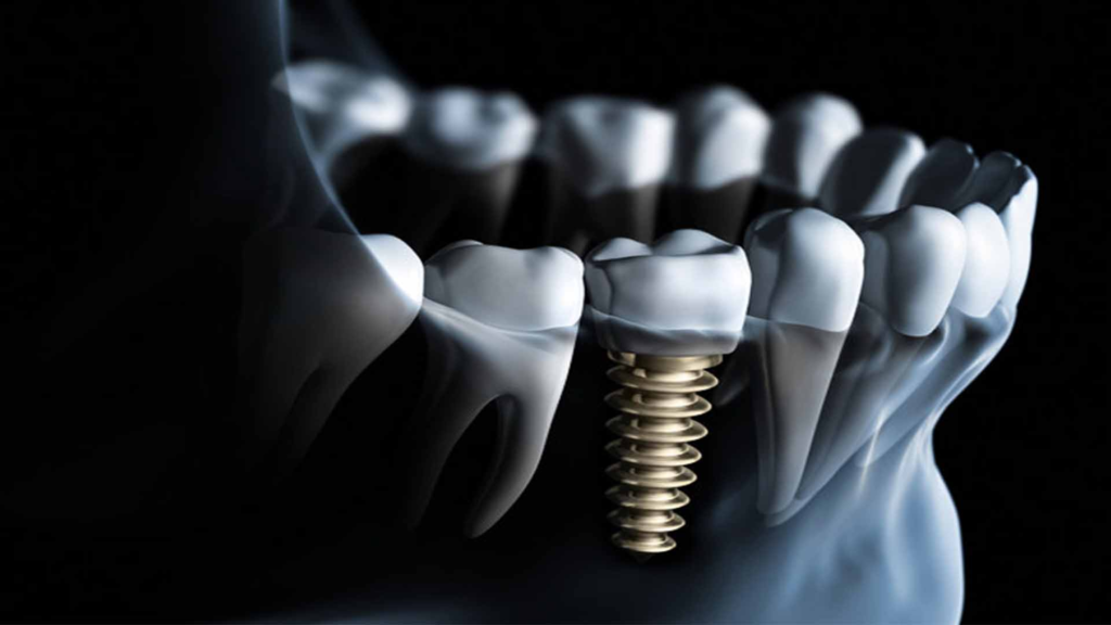 Имплантаты зубов