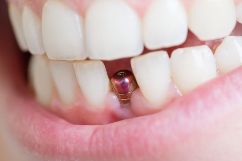Зубной имплантат после установки