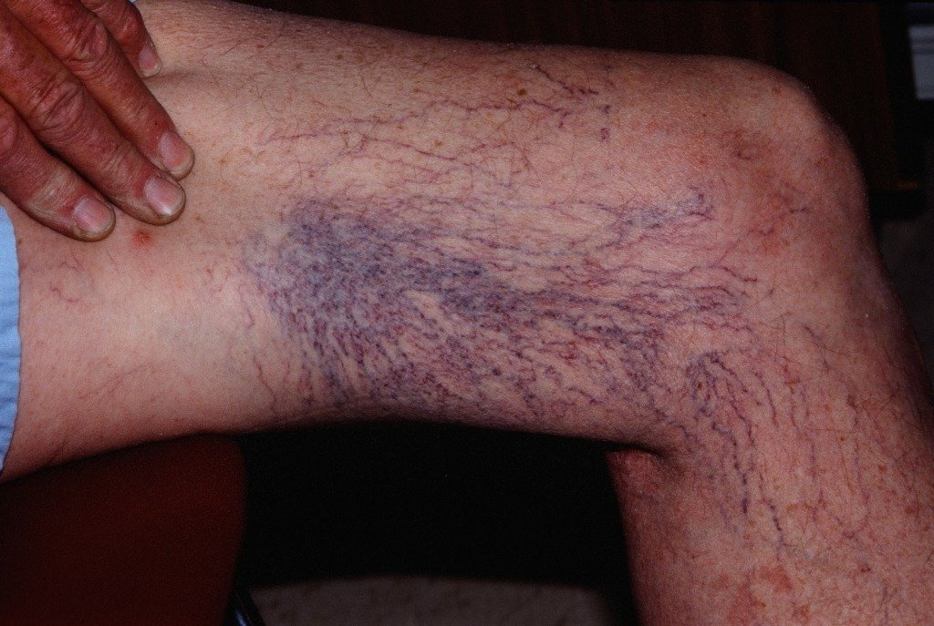 Телангиэктазии ног очень распространены у пожилых пациентов. 