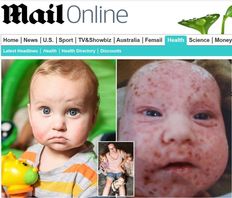 Мальчику был поставлен диагноз до 50 различных аллергии! Его жизнь - постоянное страдание