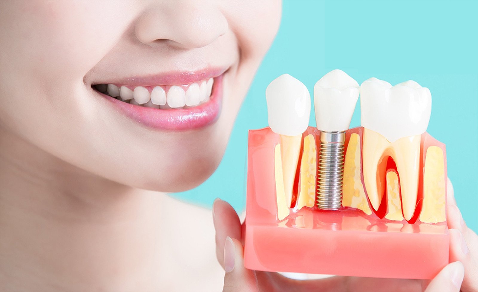 Особенности и положительные критерии имплантации зубов