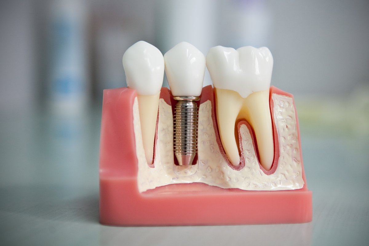 Зубные импланты в стоматологии