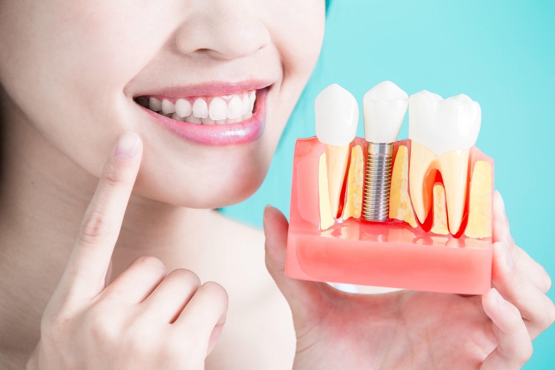 Имплантация зубов: что должен знать пациент