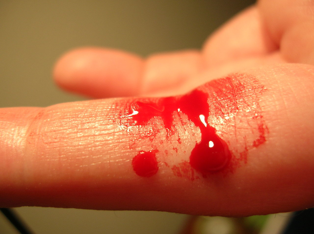 Кровотечение из пальца