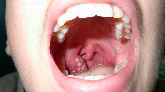 Тонзиллит и боль в горле у детей