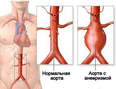 нормальная аорта и аорта с аневризмой