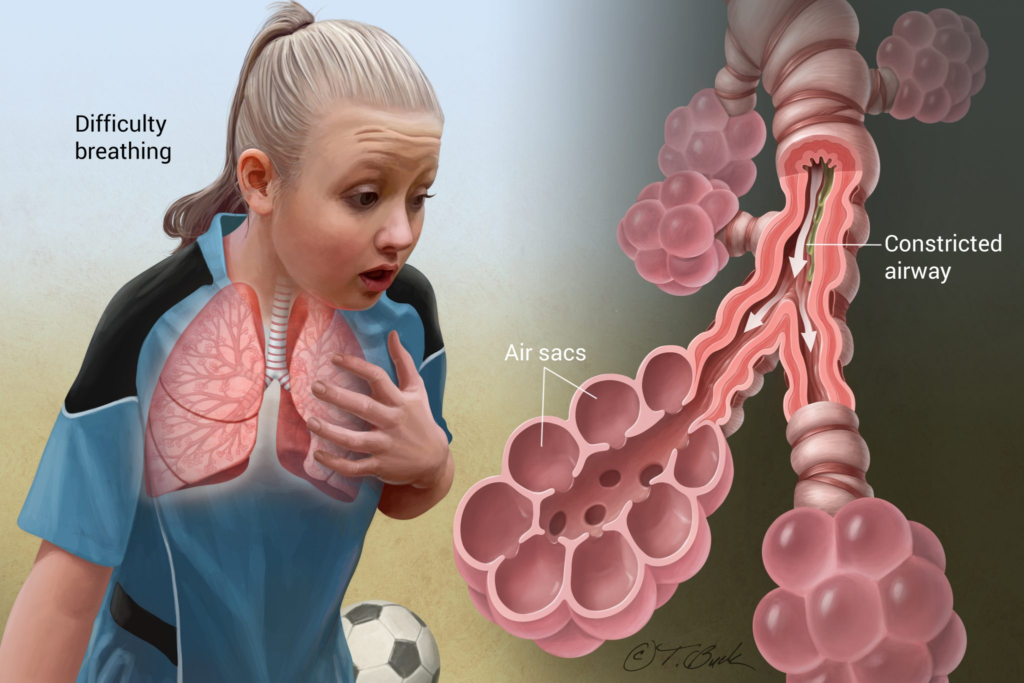 бронхиальная астма у детей и трудно дышать