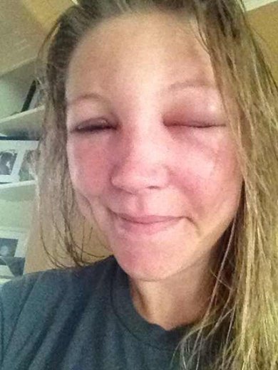 аллергия на ос у женщины