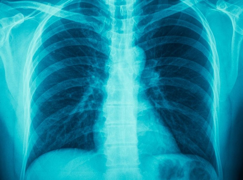пневмония рентген