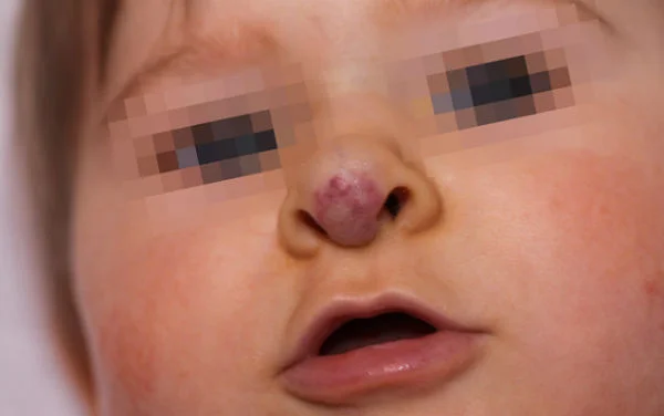 Гемангиома на носу у ребенка