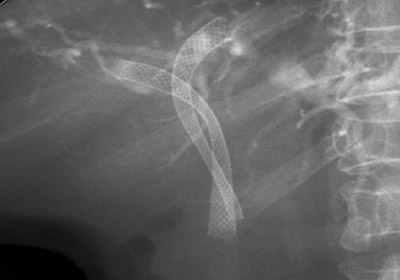 Рентгеновское изображение двух металлических стентов
