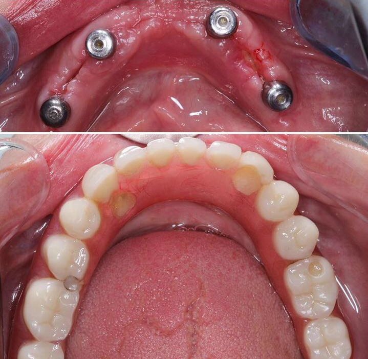 Имплантация зубов без разреза