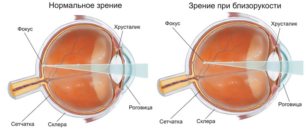 нормальное зрение и зрение при близорукости