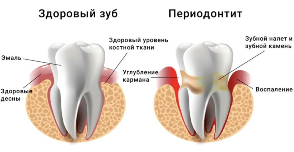 Периодонтит зубов