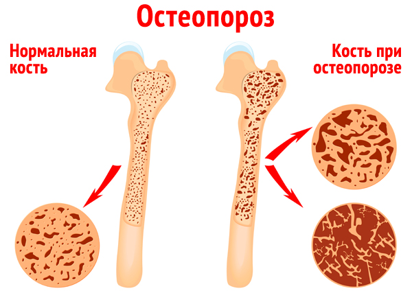 нормальные кости и кости при остеопорозе