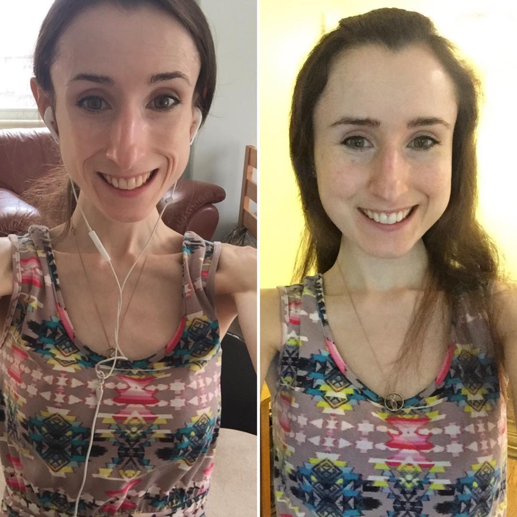 Булимия фото до и после фото