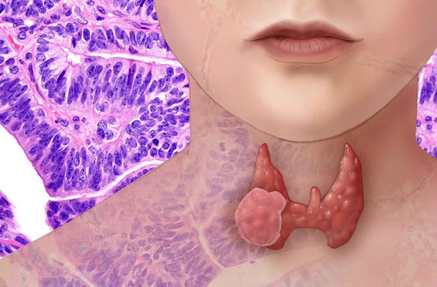 Разгадываем тайны рака щитовидной железы: от причин до лечения