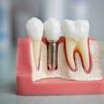 Зубные импланты в стоматологии
